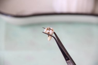 Diş tablasının arka planında cımbızla çekilen diş.