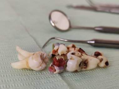 Peçetede diş aletleri ve sökülmüş dişler var.