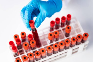 Doktor el, laboratuardaki askıdan kan örneği tüpü alıyor.