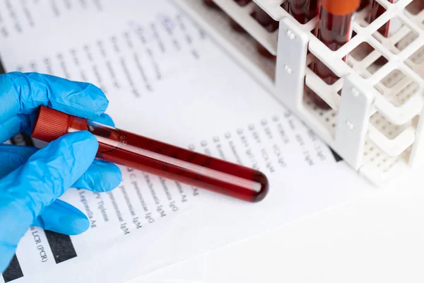 Hand Protective Glove Holding Blood Sample Vial Front Blood Test — Stock Photo, Image