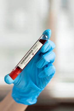 Doktorun elinde koronavirüslü kan testi tüpü var.