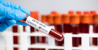 Araştırma laboratuarında kan tüpü testi yapan bir teknisyen. Coronavirus testi. Doktor laboratuardaki askıdan kan örneği alıyor.