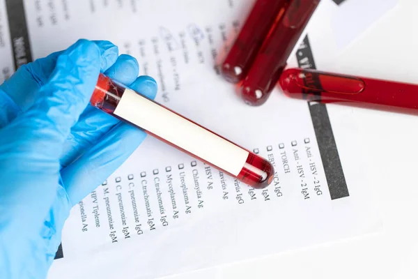 Technician Holding Blood Tube Test Research Laboratory Coronavirus Testing Doctor — Stock Photo, Image