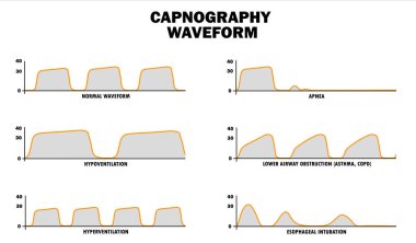 Farklı solunum şekilleri gösteren altı tıbbi kapnografi dalgası.