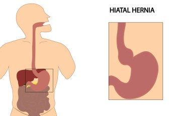 Hiatus hernia. Hiatal hernia. Types of hiatal hernia illustration clipart