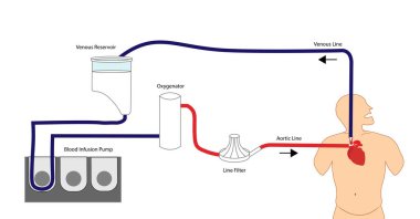 Kardiyopulmoner baypas. Extracorporeal tiraj. Kalp ameliyatı için destek tekniği. Kalp ve akciğer fonksiyonları için kullanılan makine