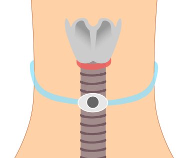 Kelepçeli trakeostomi tüpü. Trakea anatomisi ön görselleştirmesi.