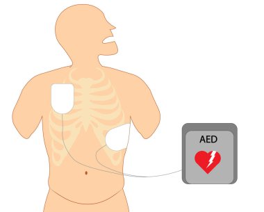Elektrot defibrilatörü pozisyonu. Elektro göğüs pozisyonu defibilatör şokuna.