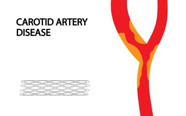 Carotid Artery Disease illustration. Carotid artery blockage. clipart