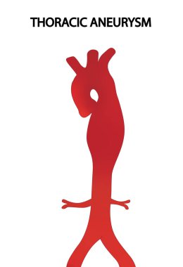 Aortik Anevrizma çizimi. Torasik aort anevrizması.