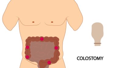 Colostomy - Illustration of colostomy bag positioning clipart