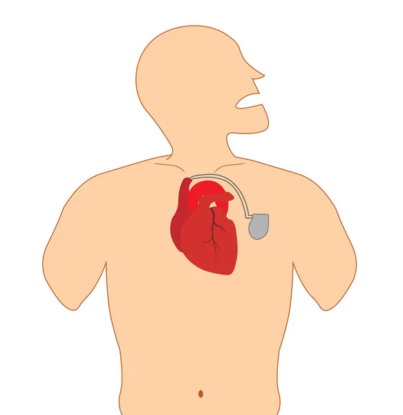 Pacemaker Collegato All Illustrazione Del Cuore — Foto Stock