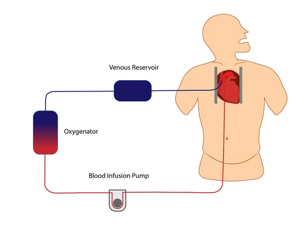 Kardiyopulmoner baypas. Extracorporeal tiraj. Kalp ameliyatı için destek tekniği. Kalp ve akciğer fonksiyonları için kullanılan makine