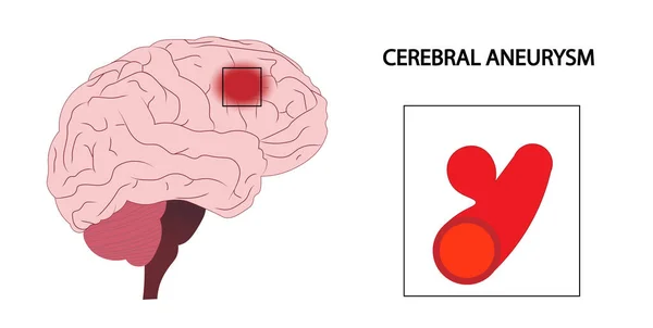 Zerebrale Aneurysma Illustration Eines Arterienaneurysmas — Stockfoto