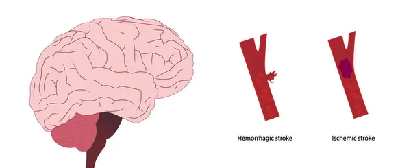 Trazos Cerebrales Ictus Isquémico Ictus Hemorrágico Diferenciar Los Tipos Golpe — Foto de Stock