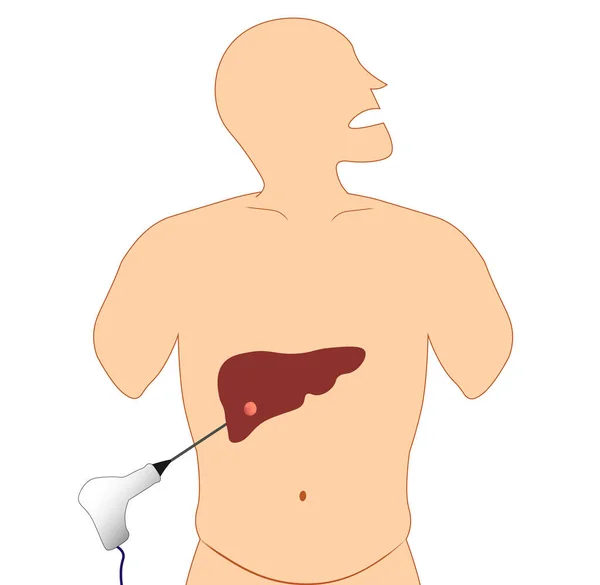 Hígado Ablación Por Radiofrecuencia Rfa Ilustración Ablación Cáncer Hígado Ablación — Foto de Stock