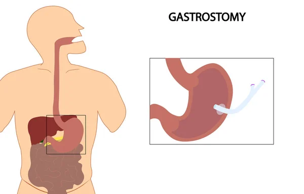 Gastrostomi çizimi. Gastrostomi tüpüyle beslenme.