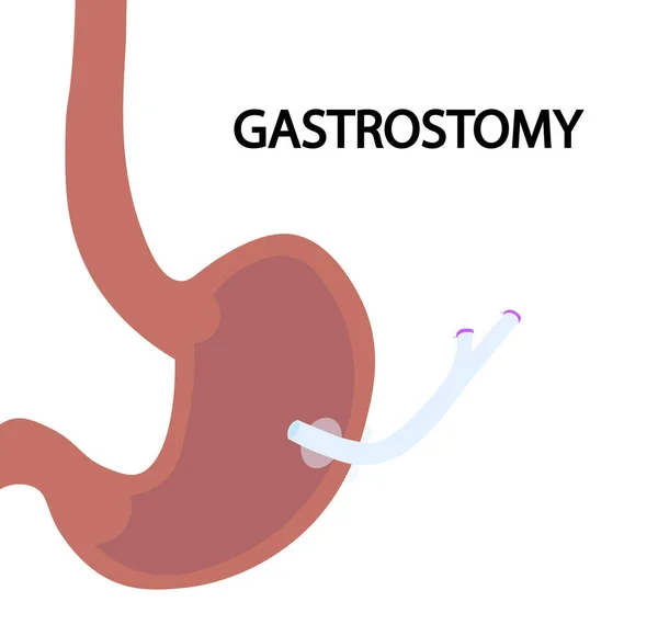 Gastrostomická Ilustrace Zásadní Výživa Krmení Pomocí Gastrostomy Trubice — Stock fotografie
