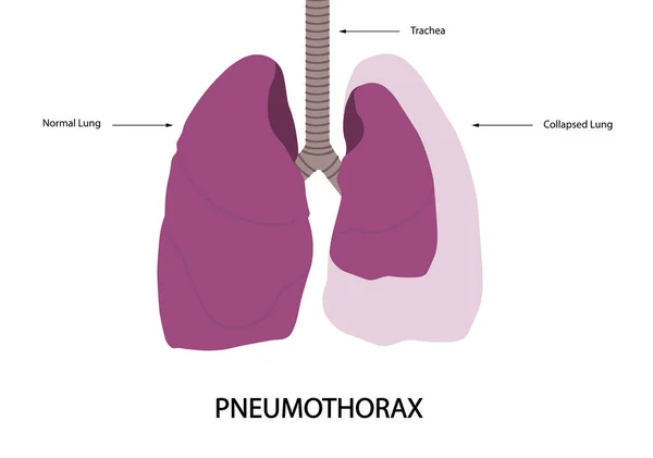 Pneumothorax Illustration Normal Lung Collapsed Lung Illustration — Stock Photo, Image