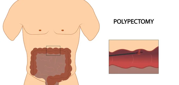 Polipi Del Colon Polipectomia Del Colon Illustrazione — Foto Stock