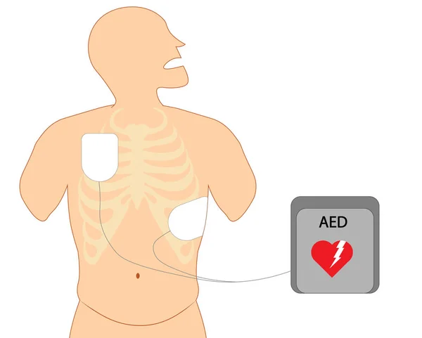 Defibrillatie Elektrode Positie Elektrode Borstpositie Aan Defibilator Schok — Stockfoto