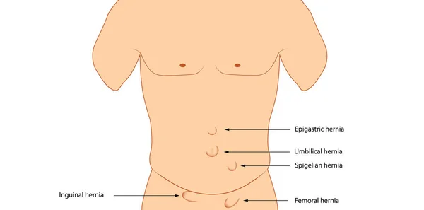 Tipos Hernia Anatomía Hernia Ilustración — Foto de Stock