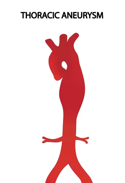 Aortik Anevrizma çizimi. Torasik aort anevrizması.