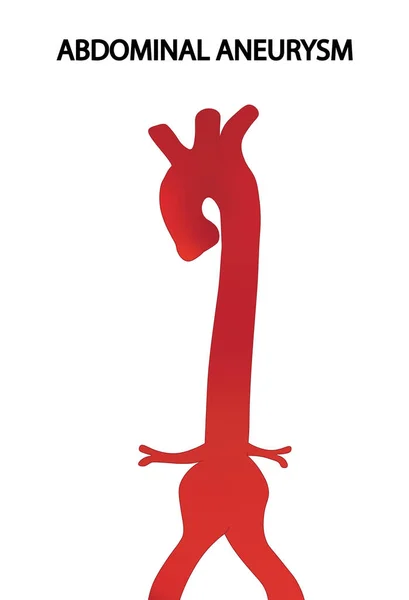 Иллюстрация Аневризма Аорты Аневризма Брюшной Аорты — стоковое фото