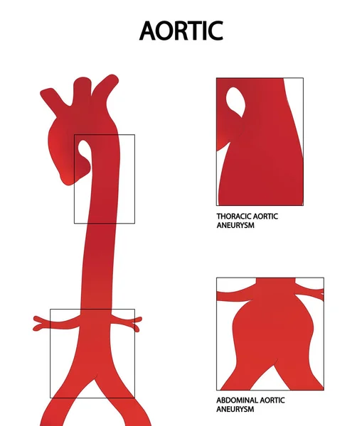 Aortik Anevrizma çizimi. Abdominal ve torasik aort anevrizması.
