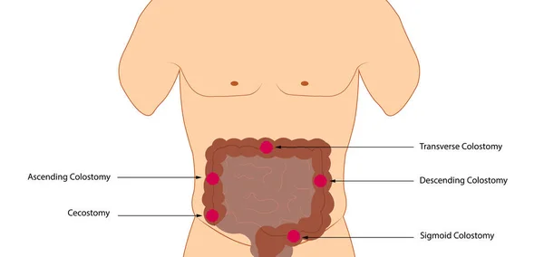 Stomanın Kolostomi Anatomisi Pozisyonu Anatomi Kolostomi Torbası Pozisyonu — Stok fotoğraf