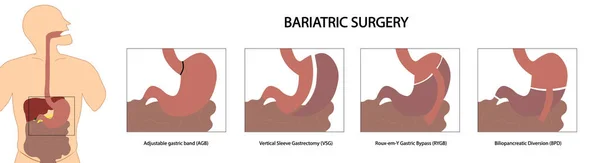 Cirugía Bariátrica Diferentes Tipos Procedimientos Bariátricos — Foto de Stock