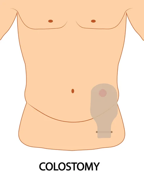 Colostomia Illustrazione Del Posizionamento Della Sacca Colostomia — Foto Stock