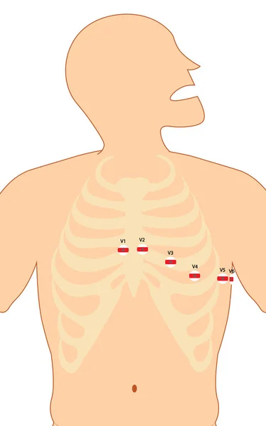 Colostomie Illustratie Van Plaats Van Colostomiezak — Stockfoto