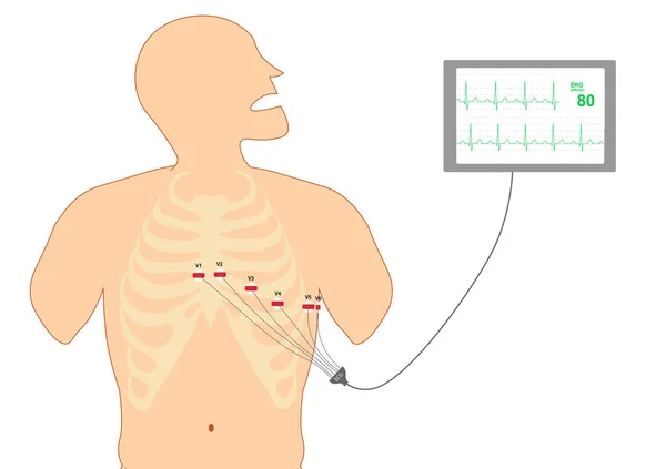 Kolostomi - Kolostomi torbasının konumu