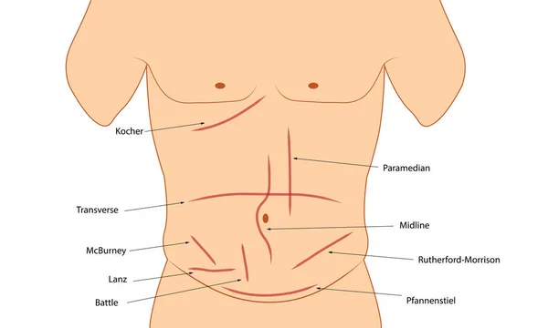 Incisión Abdominal Diferentes Tipos Incisión Abdominal Incisión Quirúrgica — Foto de Stock