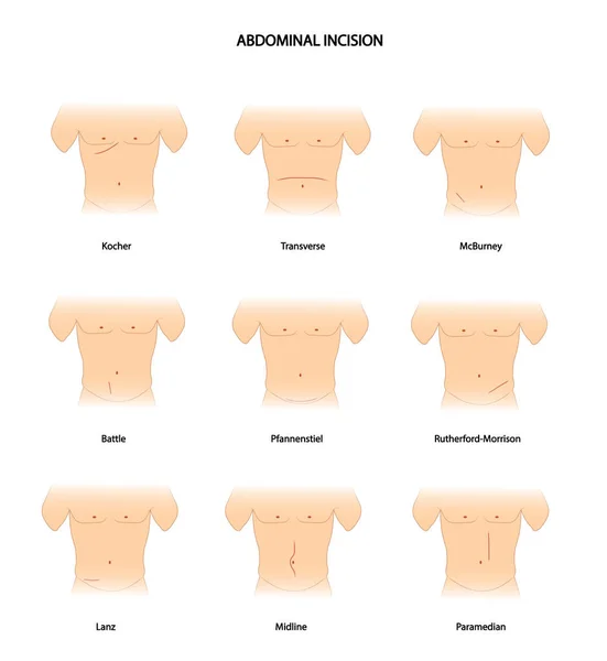 Incisión Abdominal Diferentes Tipos Incisión Abdominal Incisión Quirúrgica — Foto de Stock