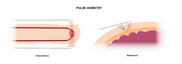 Comparación Métodos Lectura Oximetría Pulso Reflectancia Trasnmitancia —  Fotos de Stock