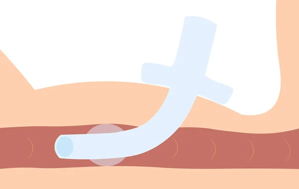 Kelepçeli trakeostomi tüpü. Soluk borusu yan görselleştirmesi.