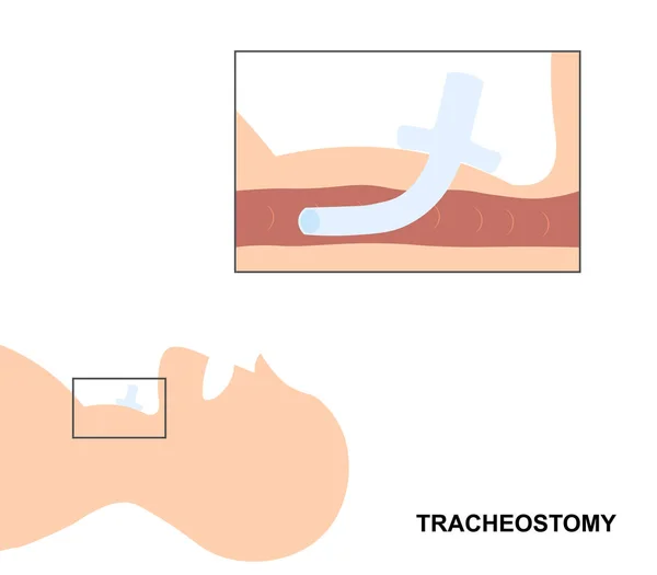 Vložení Tracheostomické Trubice Anatomie Boční Vizualizace Pro Průdušnici — Stock fotografie