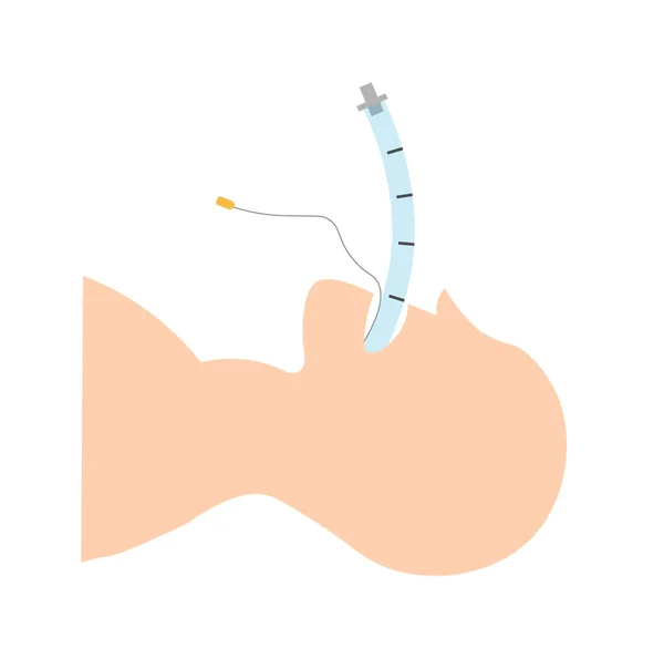Paciente Adulto Intubado Con Sonda Endotraqueal — Foto de Stock