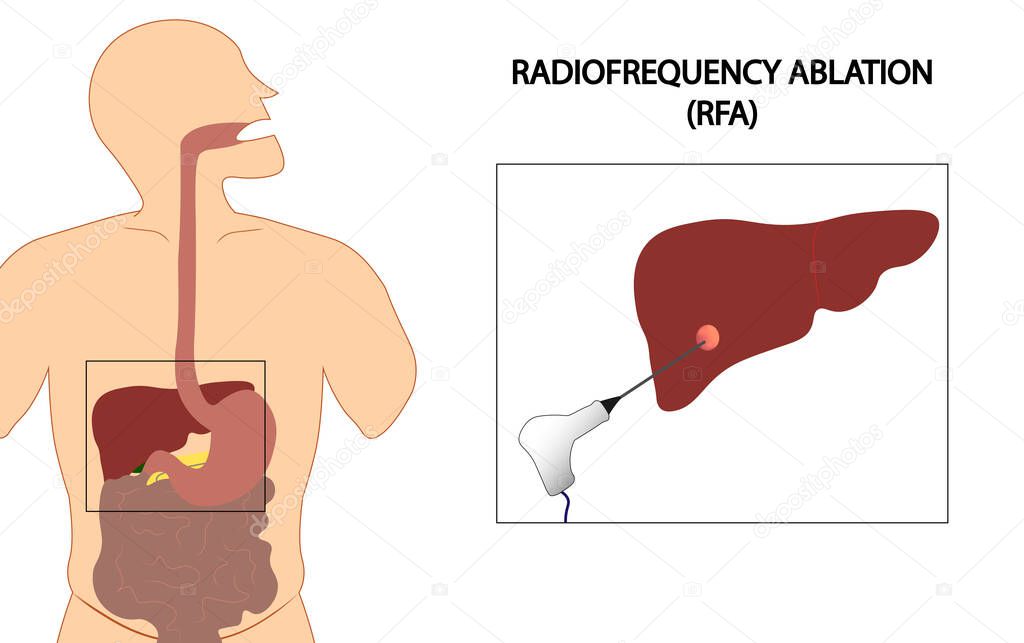Liver Radiofrequency ablation (RFA) illustration. Liver cancer ablation. Needle ablation