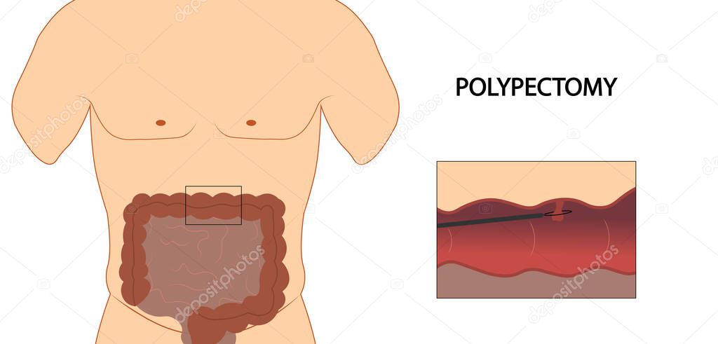 Colon polyp. Colon polypectomy illustration.