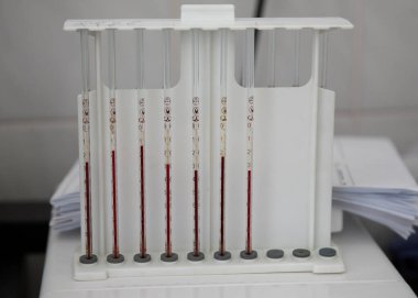 Analiz için kanlı cam pipetler. Hastalıklar ve enfeksiyonlar için laboratuvar. Kan analizi için laboratuvar ekipmanı..