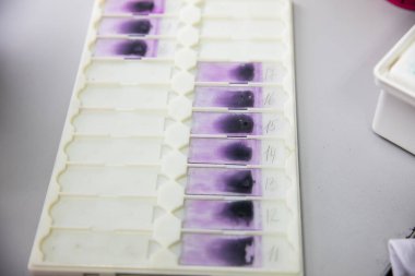 Beyaz kan hücresi formülünü hesaplamak için kan lekeleri. Laboratuvar ekipmanları. Laboratuvarda kan testleri üzerinde çalışıyorum..