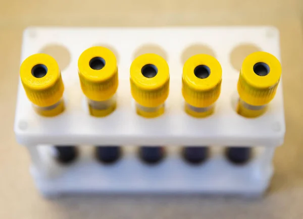 The laboratory assistant takes a test tube with blood serum for research.