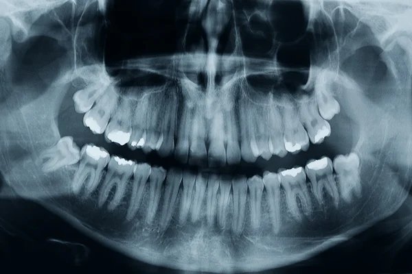 Dental xray — Stock Photo, Image