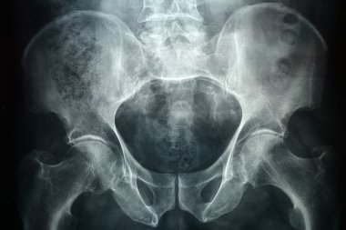 Pevic xray