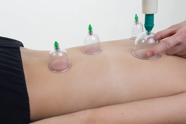 Cupping o Bekam Hijamah es un tratamiento tradicional — Foto de Stock