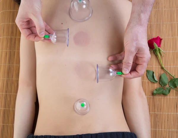 Cupping massage chinois dans une salle de médecin chinoise — Photo