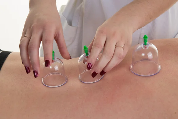 Terapeuta de acupuntura colocando la taza en la espalda de una paciente femenina — Foto de Stock